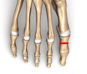 Osteotomia Akina w korekcji palucha koślawego