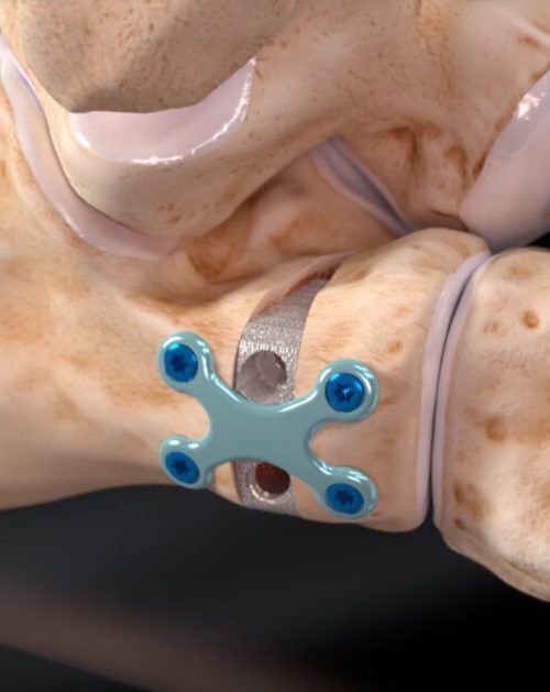 Osteotomia Evansa - operacja płaskostopia