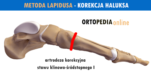 Operacja haluksa palucha koślawego metodą Lapidusa