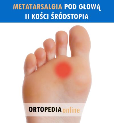 Ból stopy pod głową II kości śródstopia, odciski, metatarsalgia