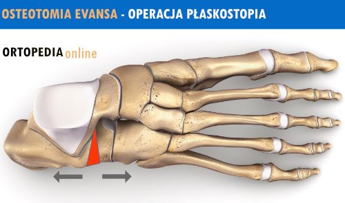 Osteotomia Evansa