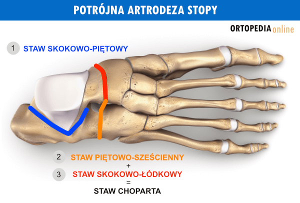 Potrójna artrodeza stopy - operacja stopy płasko-koślawej, końsko-szpotawej, zwyrodnienie stawów stopy