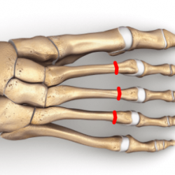 Osteotomia DMMO