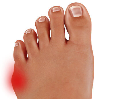 Operacja bunionette małego palca stopy