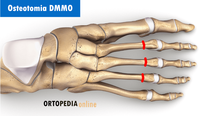 Osteotomia DMMO