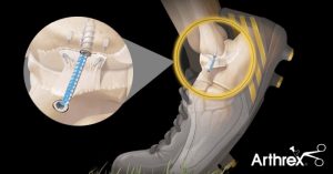 Więzadło ATFL - naprawa metodą Internal Bracing - Ortopedia Online