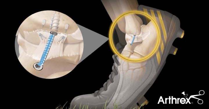ATFL Internal Bracing - naprawa więzadła skokowo-strzałkowego przedniego stawu skokowego