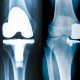 Endoproteza kolana