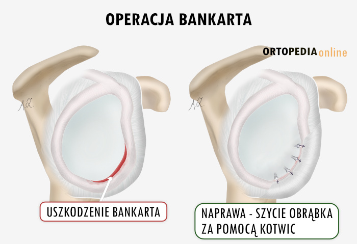 Operacja Bankarta - szycie obrąbka stawu ramiennego