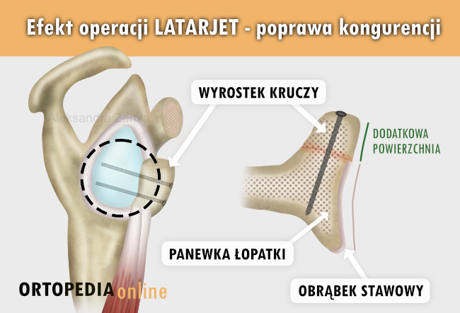 Efekt operacji Latarjet - poprawa kongurencji stawu ramiennego