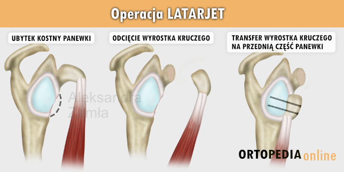 Latarjet operacja - transfer wyrostka kruczego w celu uzupełnienia panewki łopatki - leczenie niestabilności stawu ramiennego