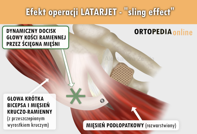 Sling effect operacji Latarjet - leczenie niestabilności stawu ramiennego