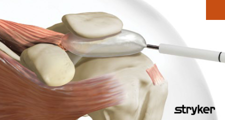 implant bakonowy inspace stryker